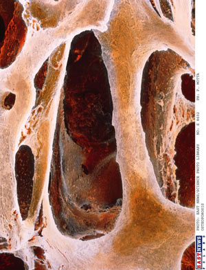 zdjęcie: osteoporoza - powiększenie, fot.: P. Motta/EastNews 