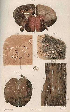 zdjęcie: Plansze z dysertacji Józefa Babińskiego z 1885 roku poświęconej stwardnieniu rozsianemu, fot. Wikipedia